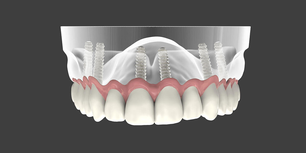 Dental Implant Supported Dentures in NYC