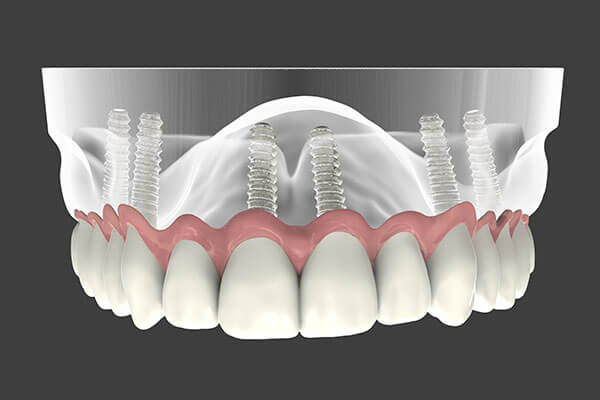 Implant Supported Dentures in Midtown