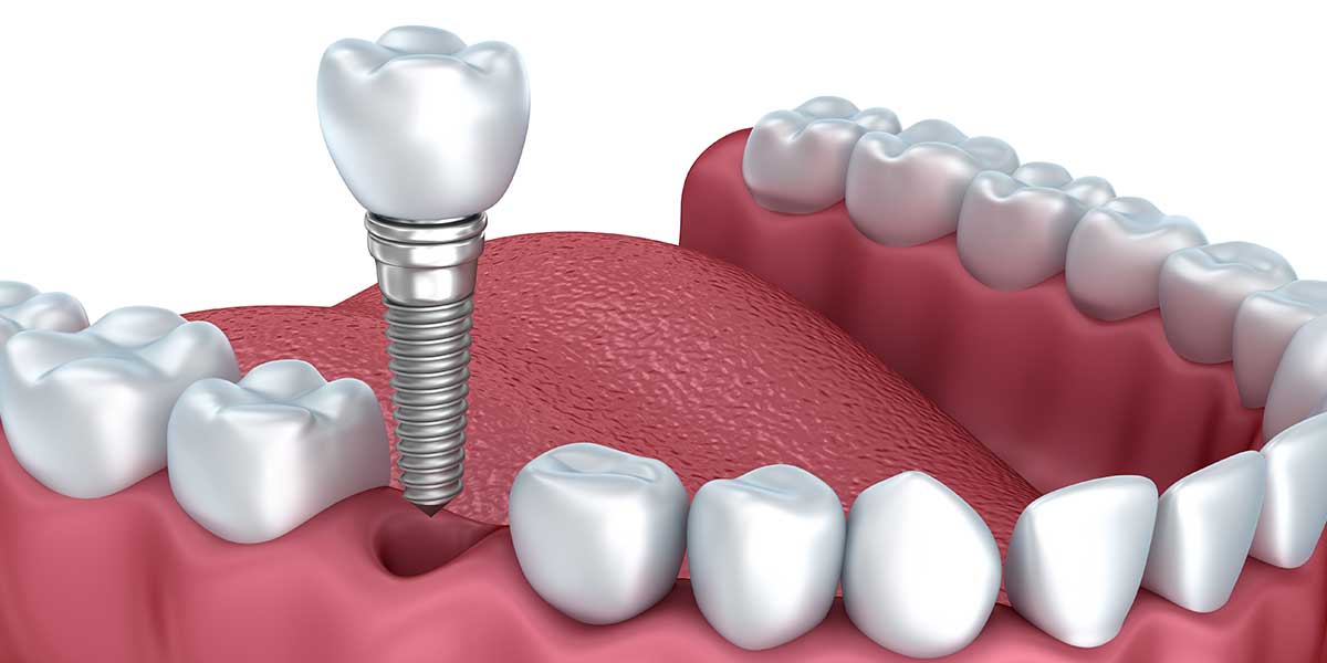 Single Tooth Dental Implant Illustration