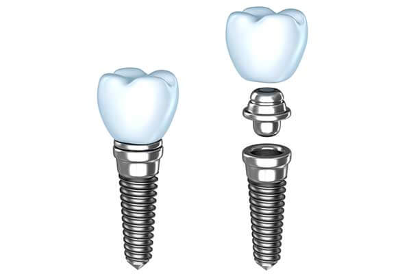 Single Dental Implants in Midtown Manhattan