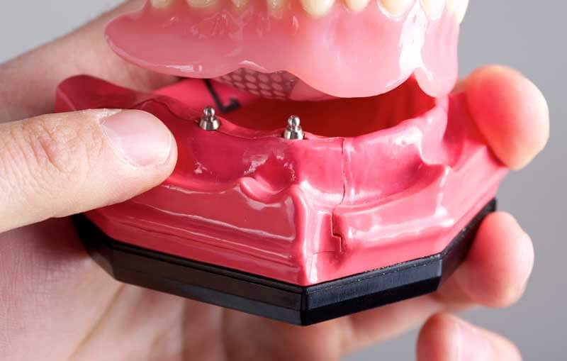 Mini Dental Implants (MDIs) in NYC